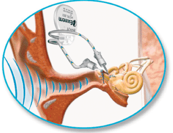 Image: The Esteem fully implantable prosthetic hearing restoration device (Photo courtesy of Envoy Medical).